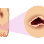 Corn Homeopathy Treatment