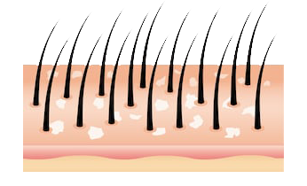 Dandruff Homeopathy Treatment Dandruff Homeopathy Treatment