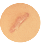 Keloid Scar Homeopathy Treatment