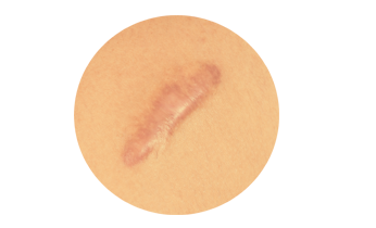 Keloid Scar Homeopathy Treatment Keloid Scar Homeopathy Treatment