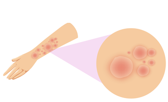 Lichen Planus Homeopathy Treatment Lichen Planus Homeopathy Treatment