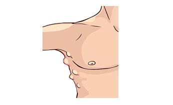 Lipoma Homeopathy Treatment Lipoma Homeopathy Treatment