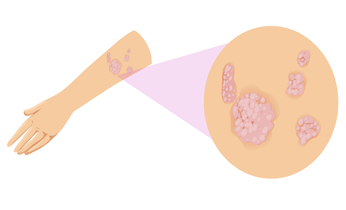 Psoriasis Homeopathy Treatment Psoriasis Homeopathy Treatment