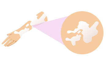 Vitiligo Homeopathy Treatment Vitiligo Homeopathy Treatment