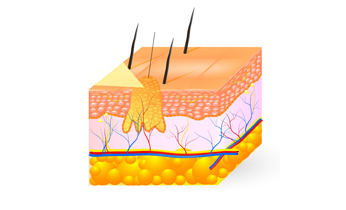 Wart Homeopathy Treatment Wart Homeopathy Treatment